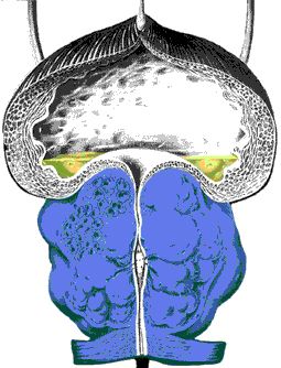 Cetrorelix Pamoate tüneti benignus prosztata hipertrófiában (BPH) szenvedő betegeknél