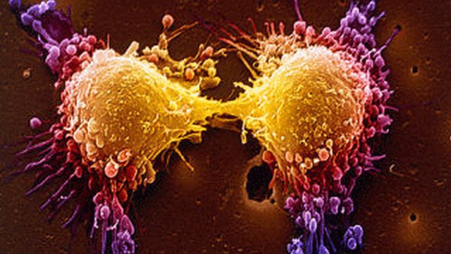 A rák tünetei a vérképben: 3 adat, ami veszélyt jelezhet - Egészség | Femina