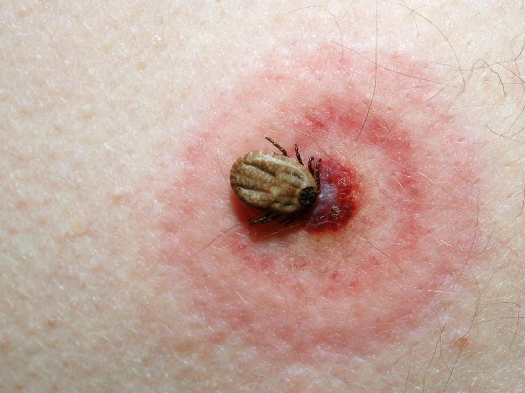A Lyme-kór tünetei és kezelése: így ismerje fel a kullancs okozta fertőzést - EgészségKalauz